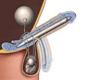 http://www.beliefnet.com/healthandhealing/images/penile_implant_smaller.jpg